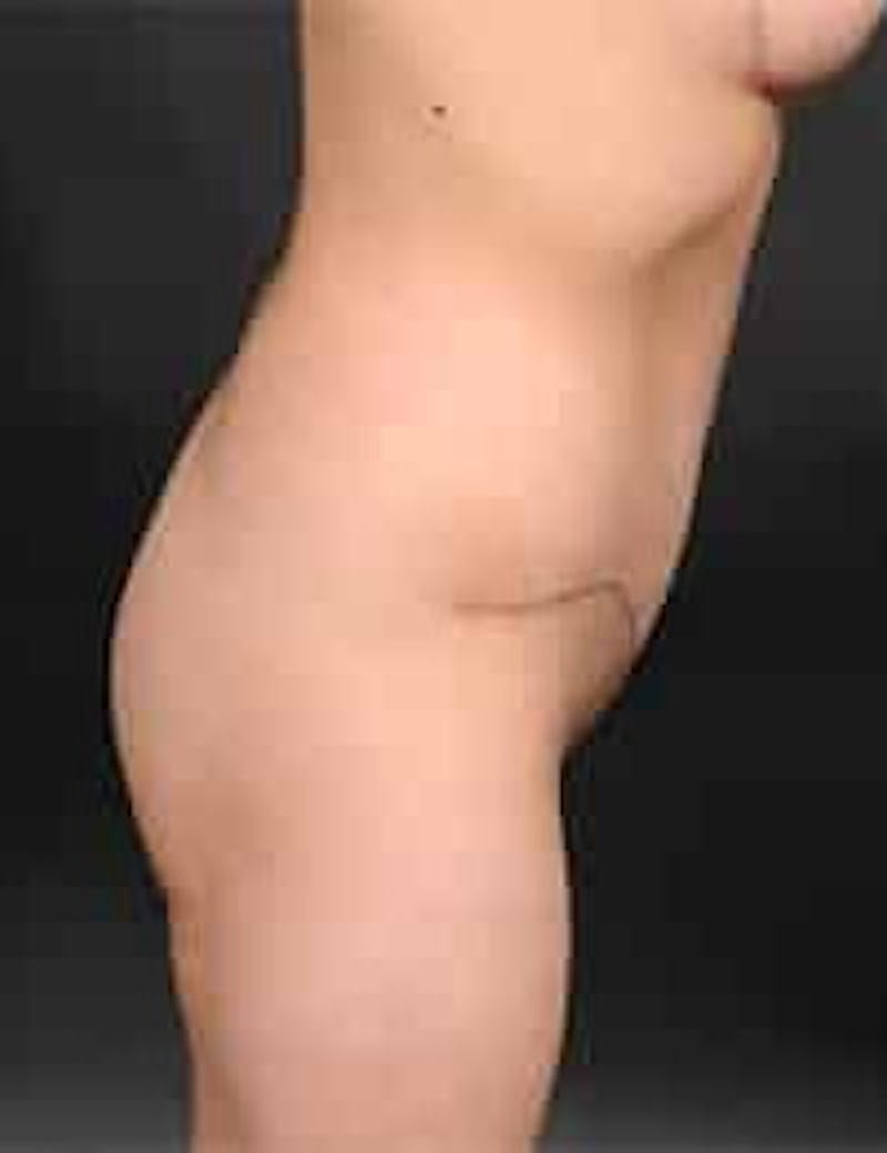 Tummy Tuck Before & After Gallery - Patient 211523 - Image 4
