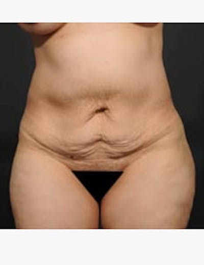 Tummy Tuck Before & After Gallery - Patient 105720 - Image 1