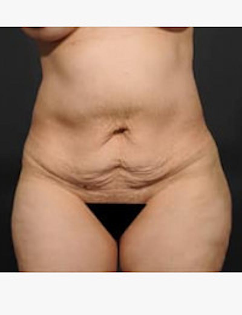Tummy Tuck Before & After Gallery - Patient 105720 - Image 1