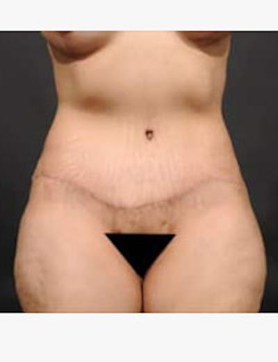 Tummy Tuck Before & After Gallery - Patient 105720 - Image 2