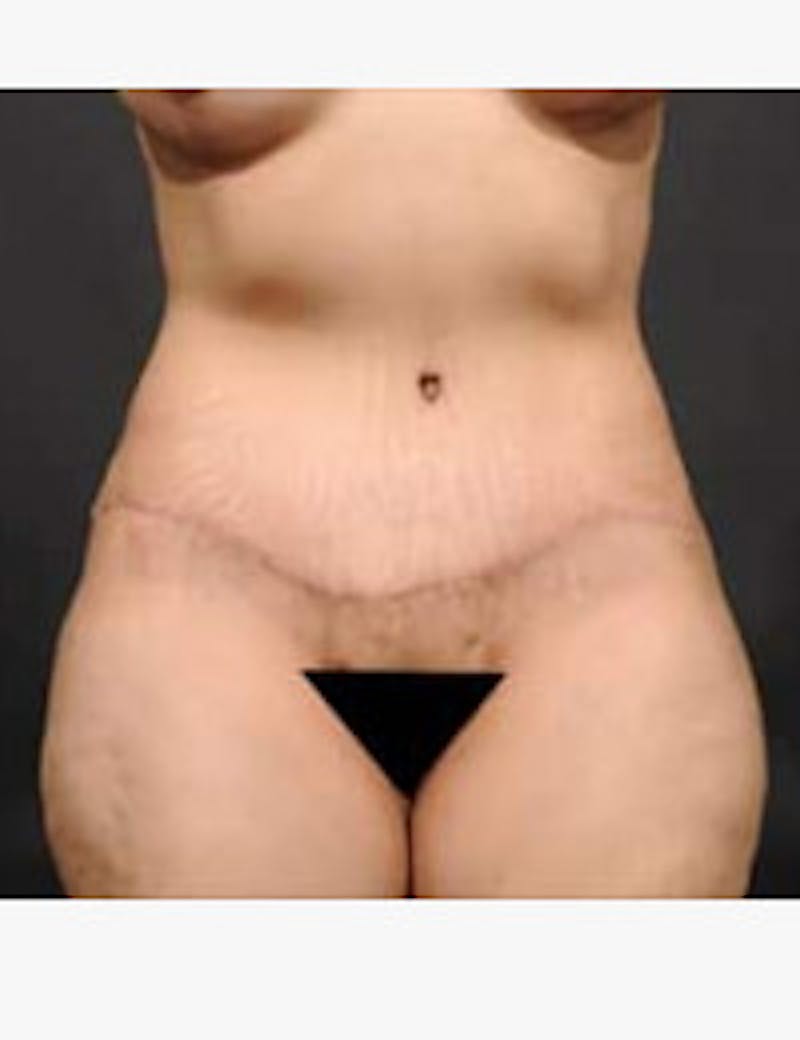 Tummy Tuck Before & After Gallery - Patient 105720 - Image 2
