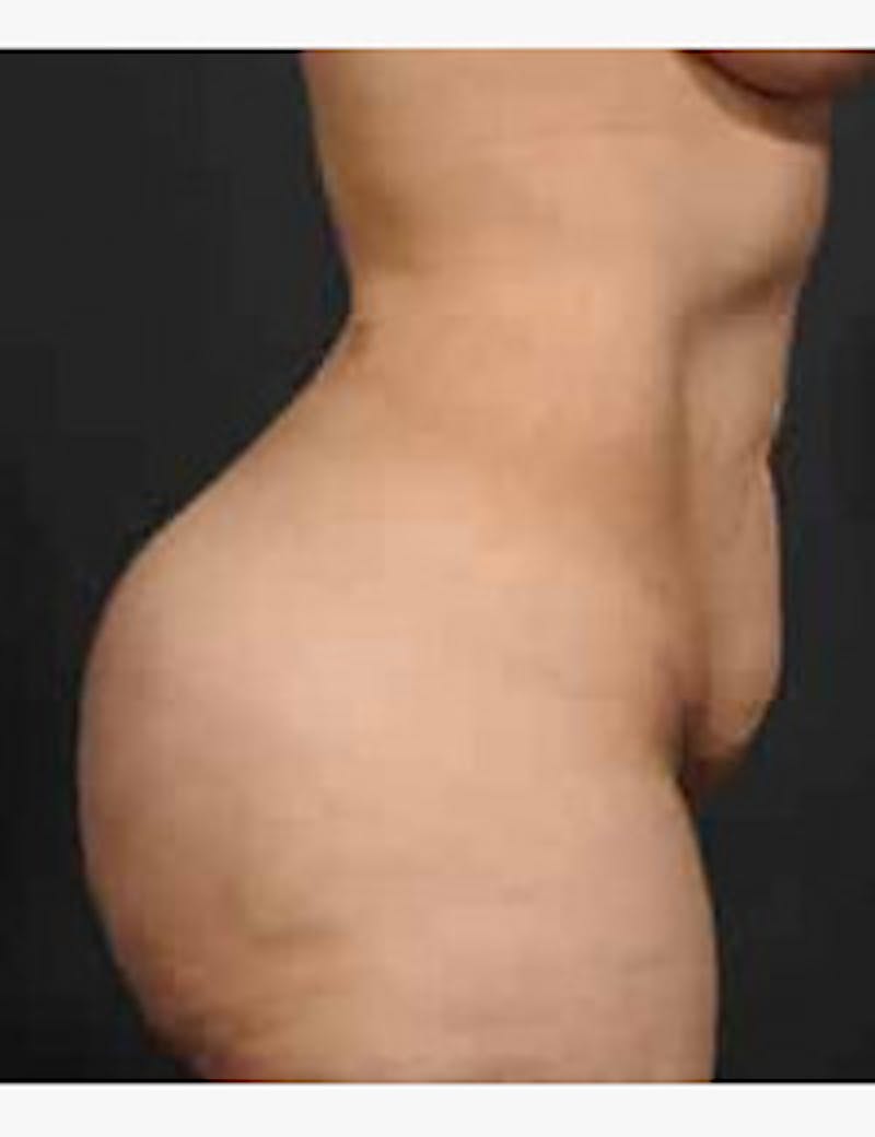 Tummy Tuck Before & After Gallery - Patient 105720 - Image 3