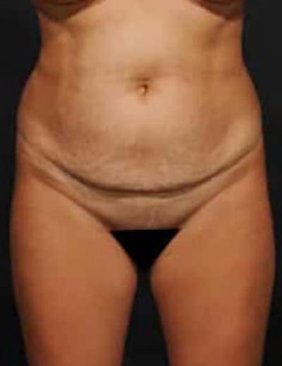 Tummy Tuck Before & After Gallery - Patient 278177 - Image 1