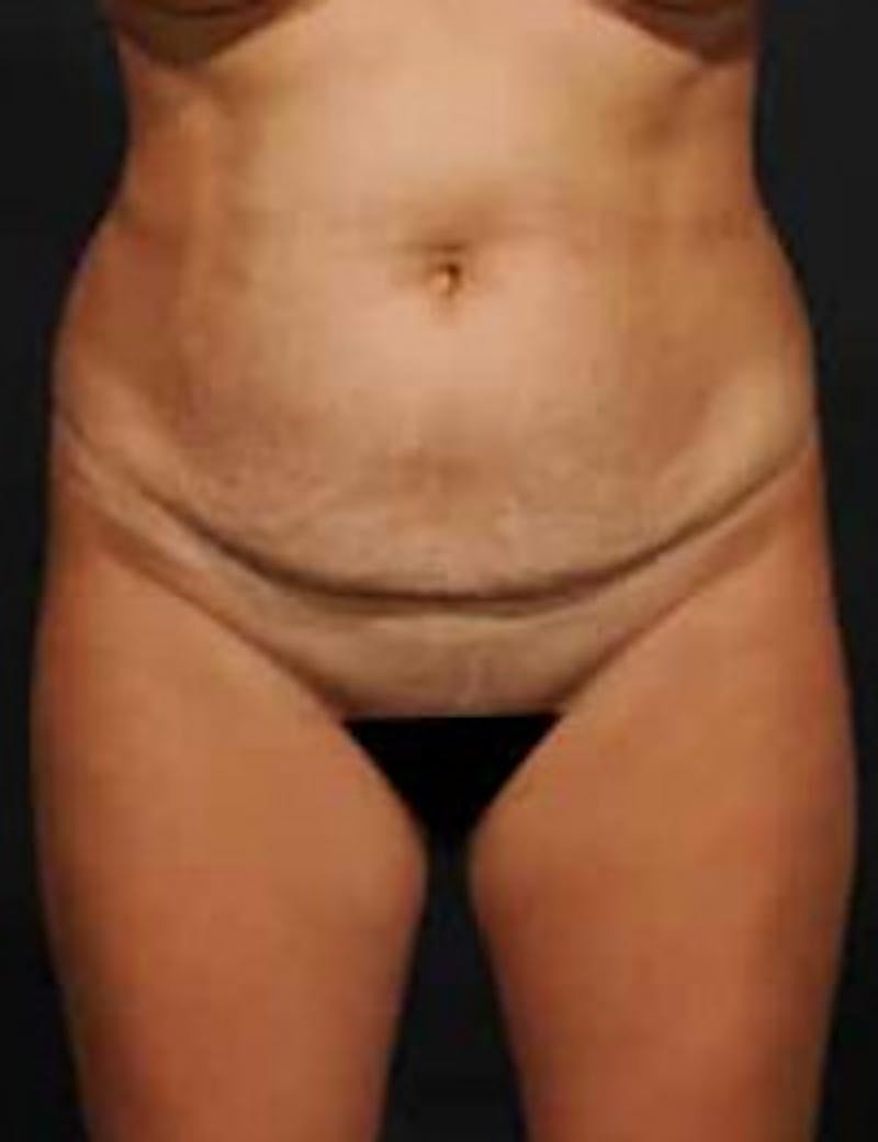 Tummy Tuck Before & After Gallery - Patient 278177 - Image 1