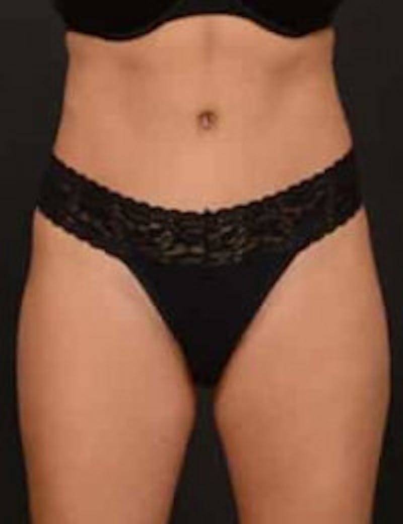 Tummy Tuck Before & After Gallery - Patient 278177 - Image 2