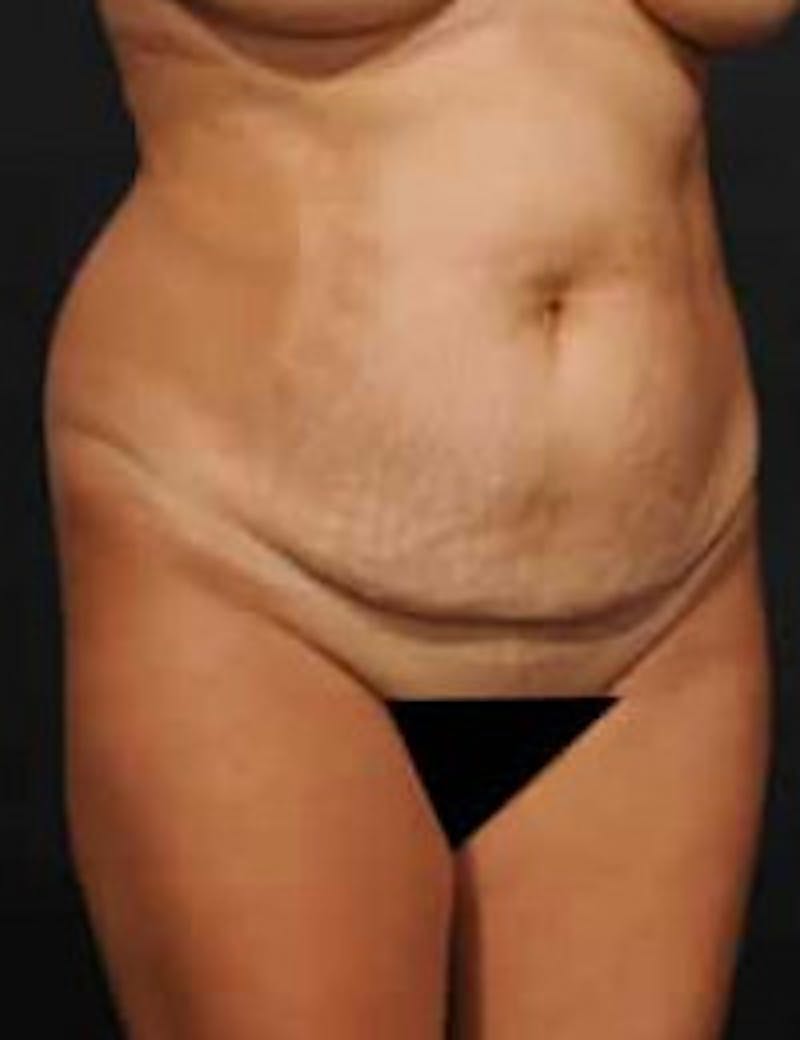 Tummy Tuck Before & After Gallery - Patient 278177 - Image 3