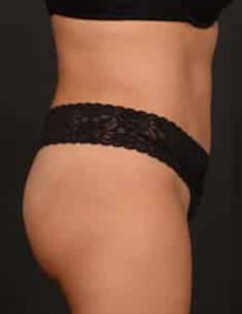 Tummy Tuck Before & After Gallery - Patient 278177 - Image 6