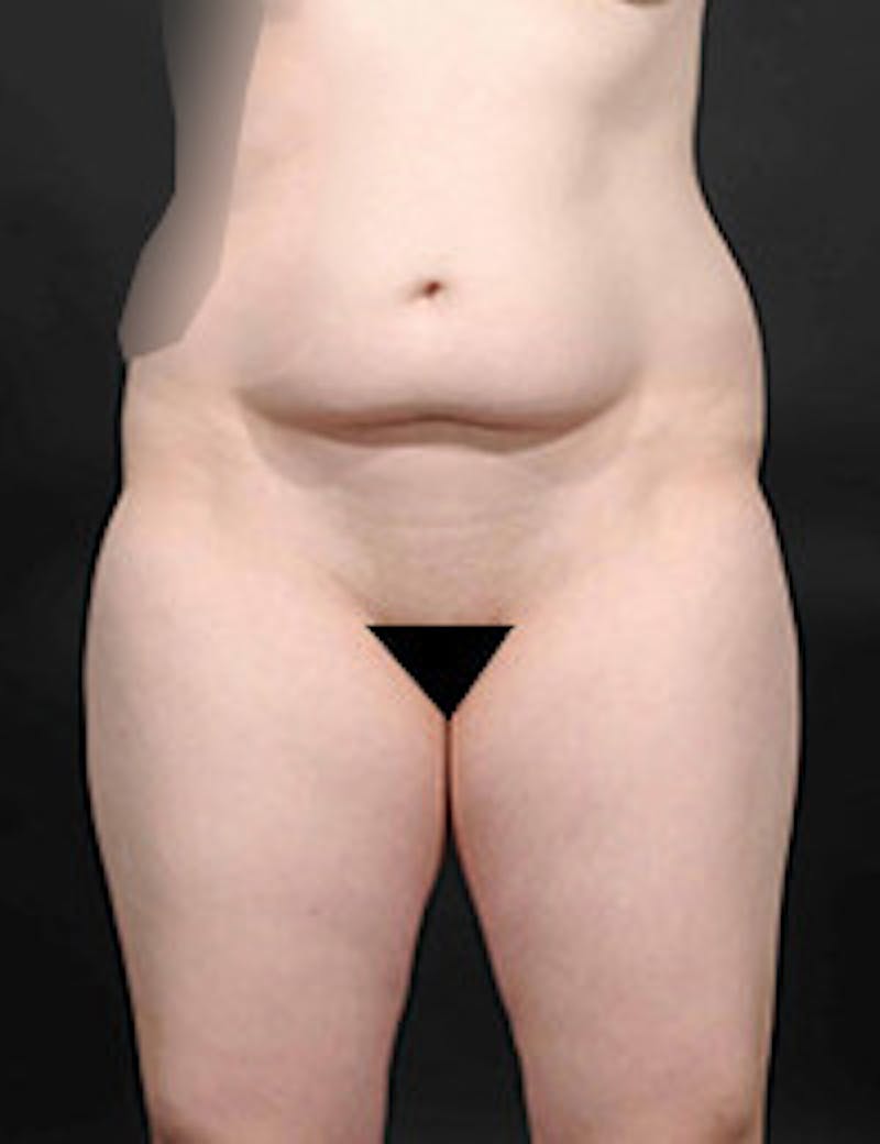 Tummy Tuck Before & After Gallery - Patient 409990 - Image 1