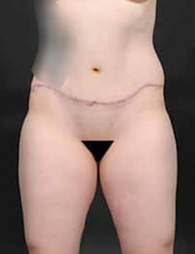 Tummy Tuck Before & After Gallery - Patient 409990 - Image 2