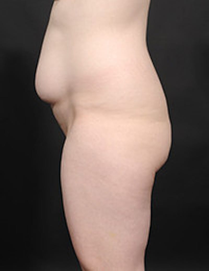 Tummy Tuck Before & After Gallery - Patient 409990 - Image 3