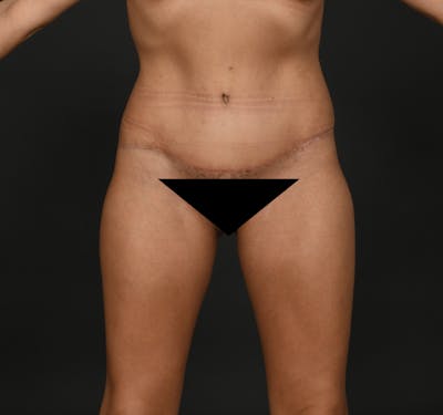 Tummy Tuck Before & After Gallery - Patient 299316 - Image 2