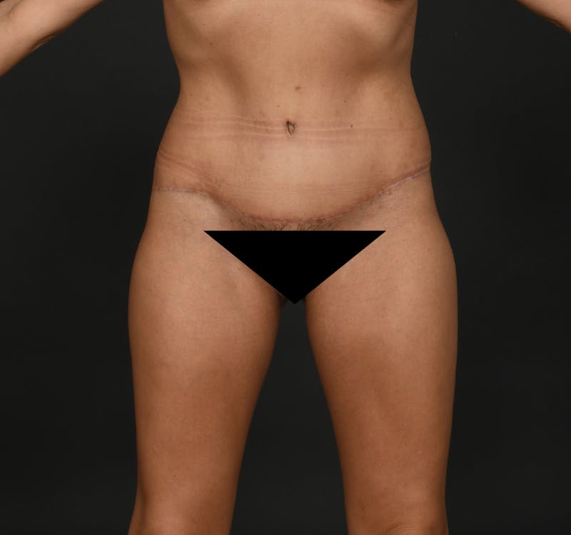 Tummy Tuck Before & After Gallery - Patient 299316 - Image 2