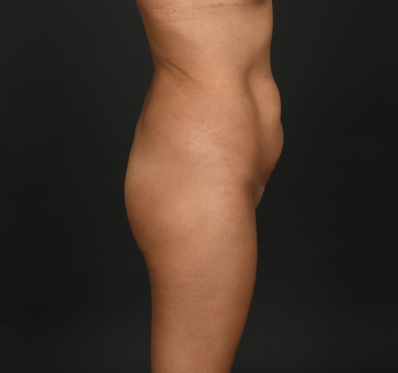 Tummy Tuck Before & After Gallery - Patient 299316 - Image 4