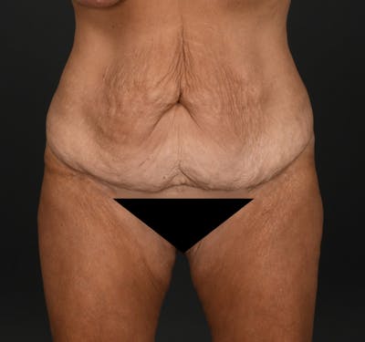 Tummy Tuck Before & After Gallery - Patient 148727 - Image 1