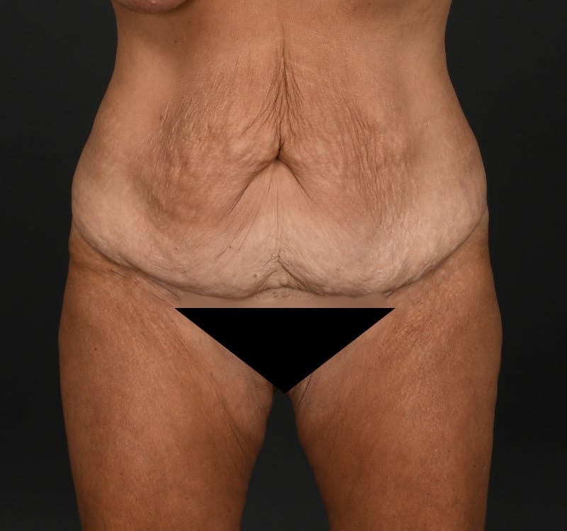 Tummy Tuck Before & After Gallery - Patient 148727 - Image 1