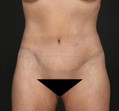 Tummy Tuck Before & After Gallery - Patient 148727 - Image 2