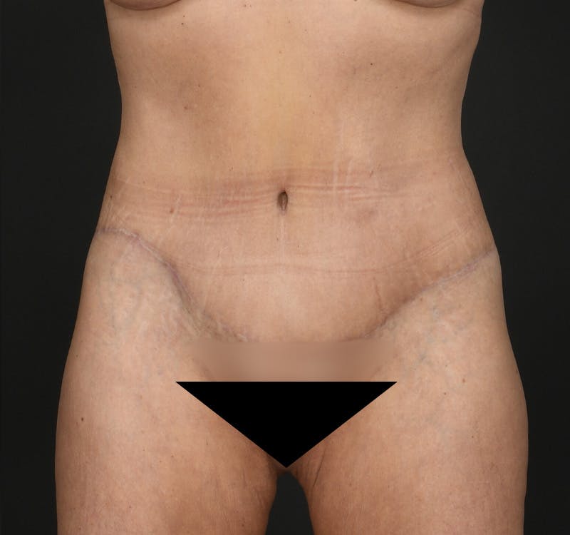 Tummy Tuck Before & After Gallery - Patient 148727 - Image 2