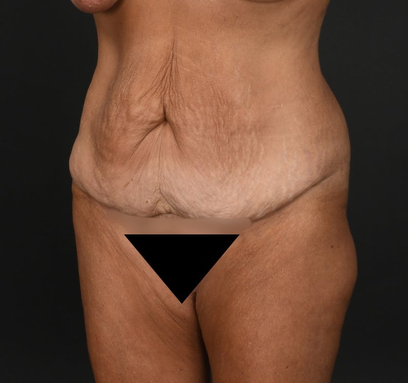 Tummy Tuck Before & After Gallery - Patient 148727 - Image 3