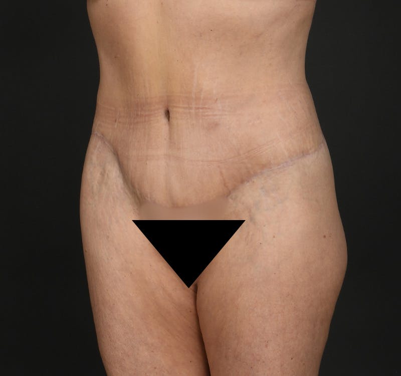 Tummy Tuck Before & After Gallery - Patient 148727 - Image 4
