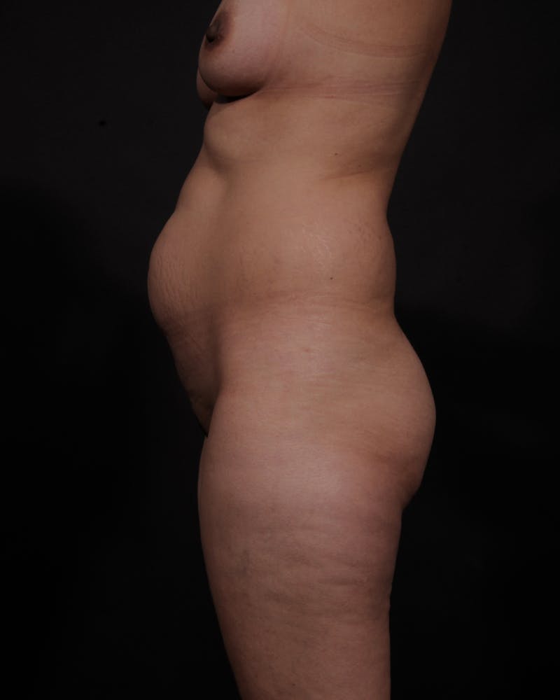 Mommy Makeover Before & After Gallery - Patient 370700 - Image 5