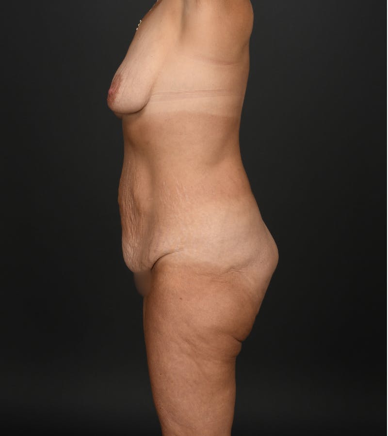 Mommy Makeover Before & After Gallery - Patient 203131 - Image 7