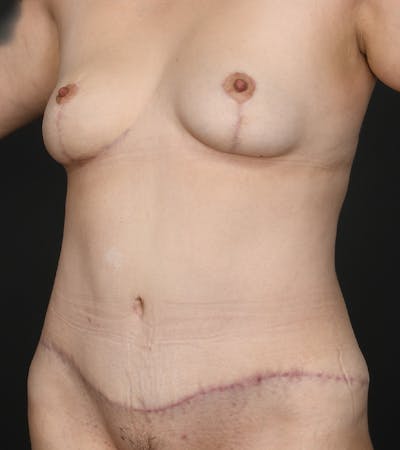 Mommy Makeover Before & After Gallery - Patient 307266 - Image 2