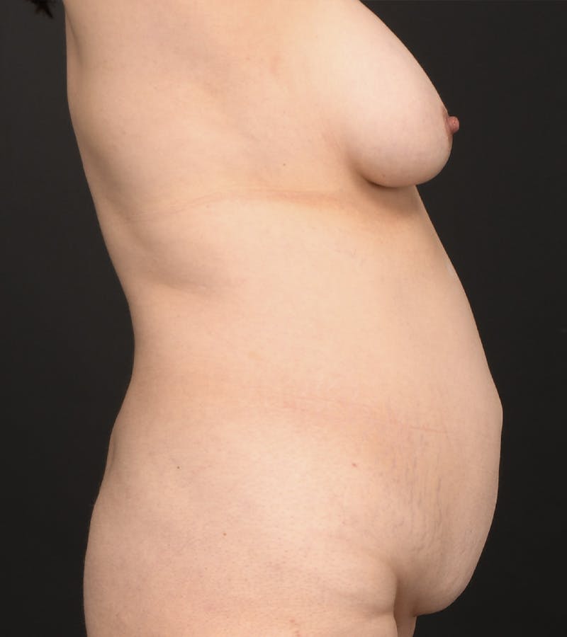 Mommy Makeover Before & After Gallery - Patient 307266 - Image 3