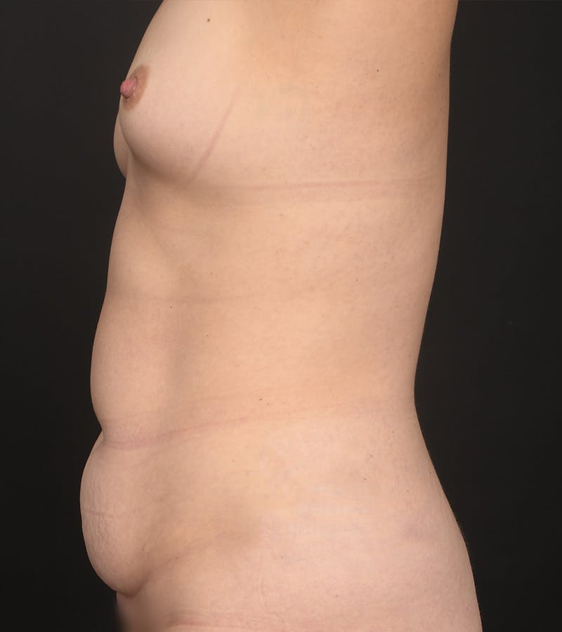 Mommy Makeover Before & After Gallery - Patient 271983 - Image 5