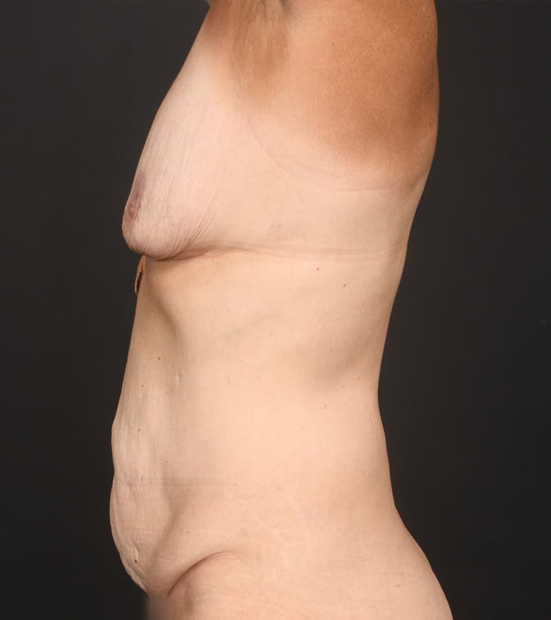 Mommy Makeover Before & After Gallery - Patient 385909 - Image 7