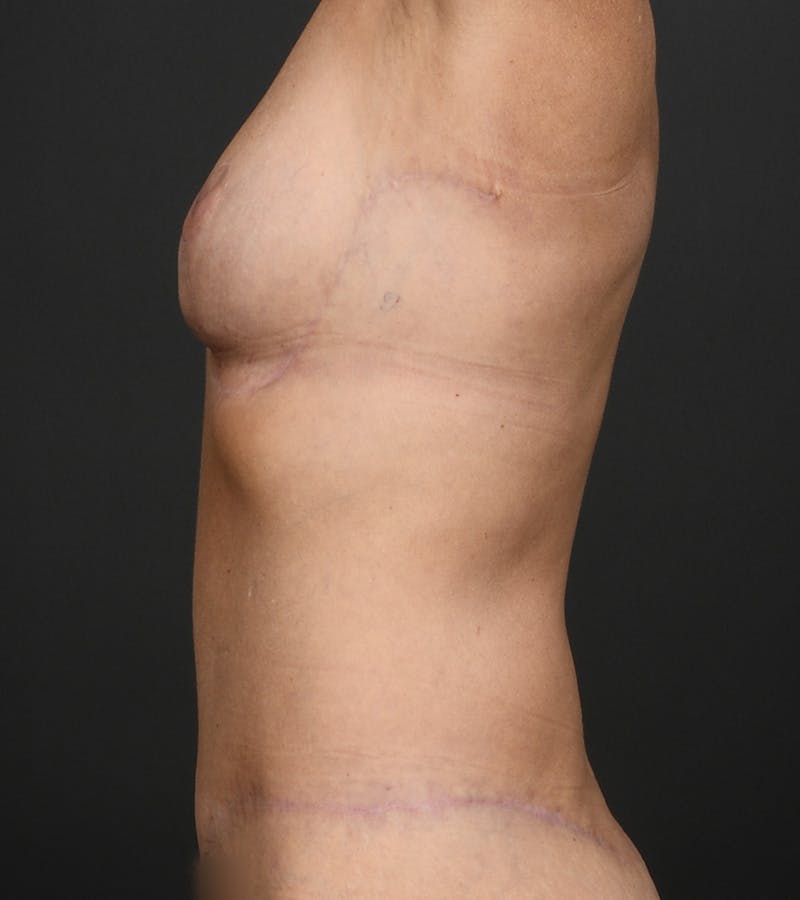 Mommy Makeover Before & After Gallery - Patient 385909 - Image 8