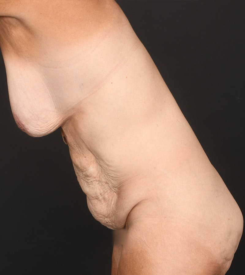 Mommy Makeover Before & After Gallery - Patient 385909 - Image 9