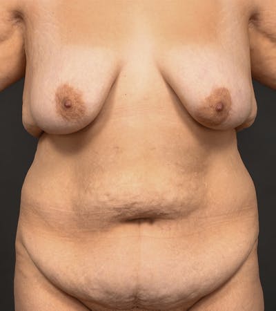Mommy Makeover Before & After Gallery - Patient 406571 - Image 1