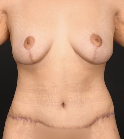 Mommy Makeover Before & After Gallery - Patient 406571 - Image 2