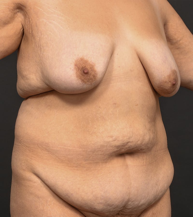 Mommy Makeover Before & After Gallery - Patient 406571 - Image 3