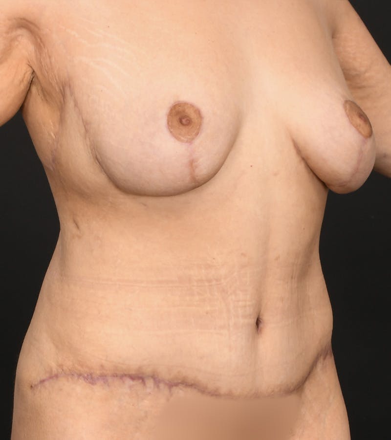 Mommy Makeover Before & After Gallery - Patient 406571 - Image 4