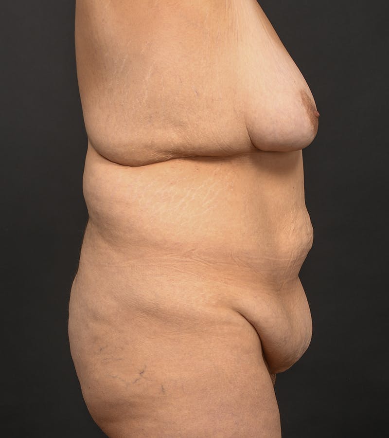 Mommy Makeover Before & After Gallery - Patient 406571 - Image 5