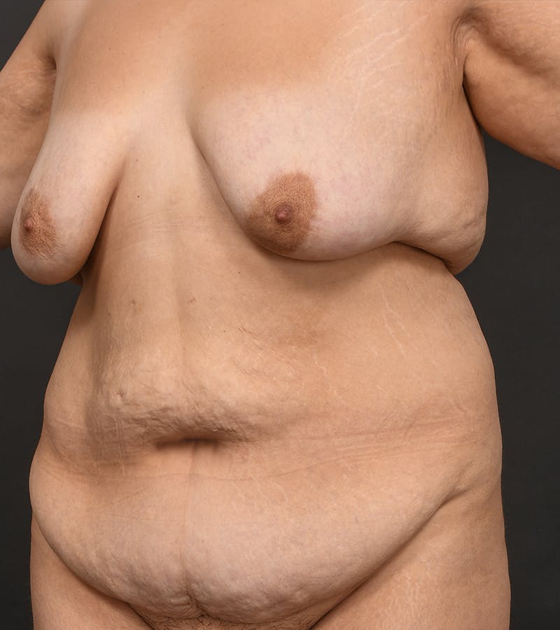 Mommy Makeover Before & After Gallery - Patient 406571 - Image 7