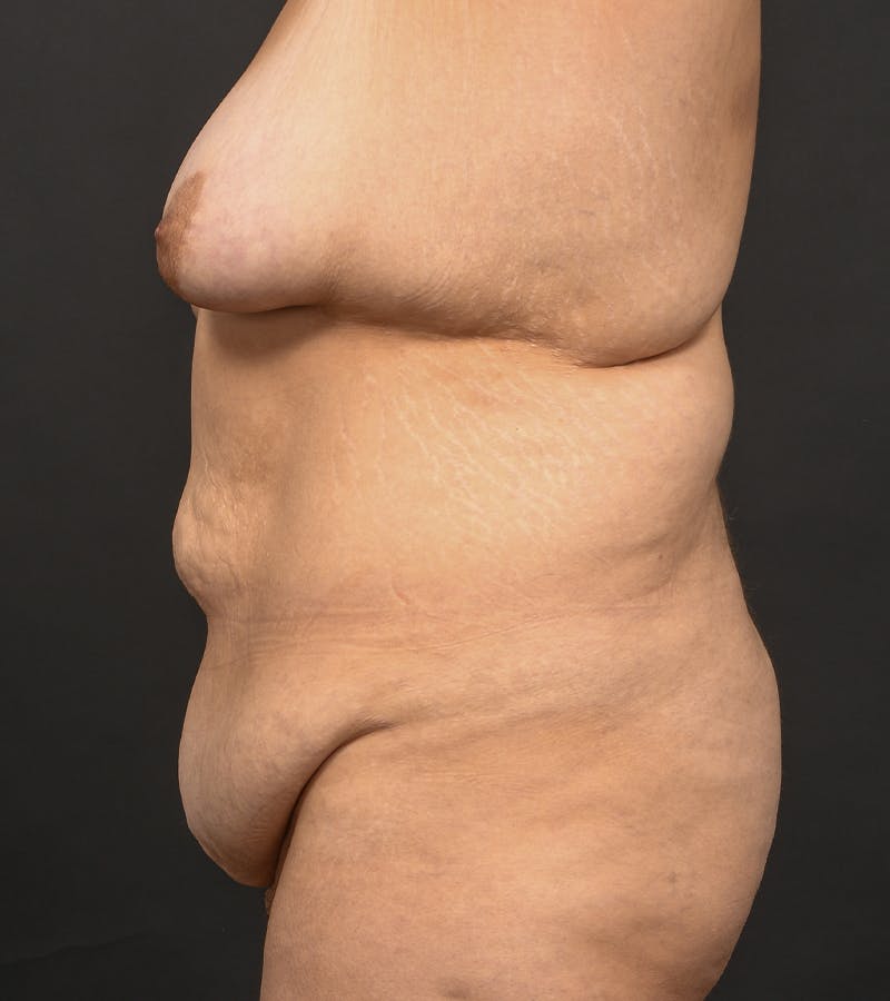 Mommy Makeover Before & After Gallery - Patient 406571 - Image 9