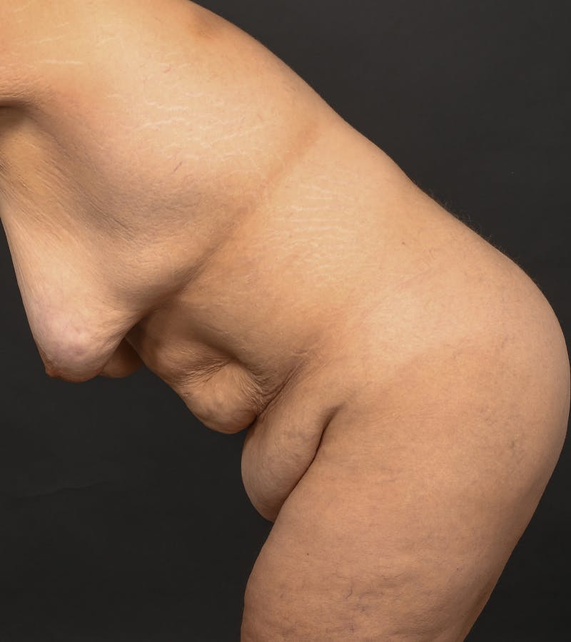 Mommy Makeover Before & After Gallery - Patient 406571 - Image 11