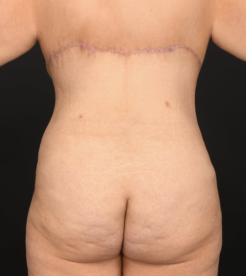 Mommy Makeover Before & After Gallery - Patient 406571 - Image 14