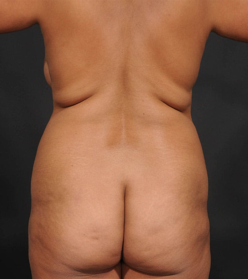 Mommy Makeover Before & After Gallery - Patient 272601 - Image 9