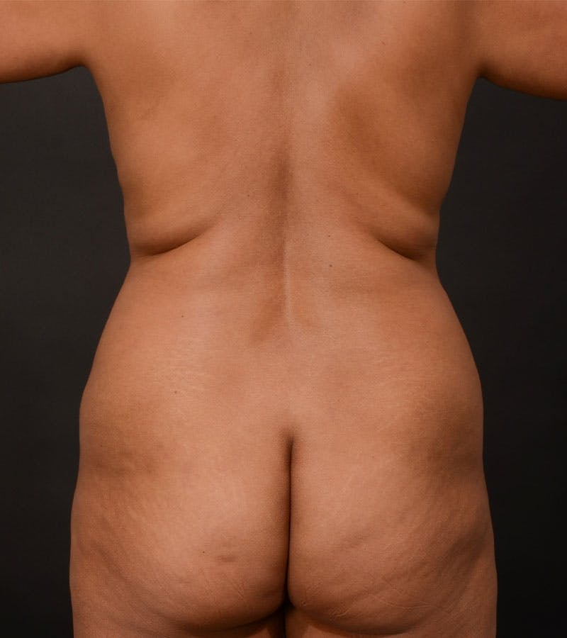 Mommy Makeover Before & After Gallery - Patient 272601 - Image 10