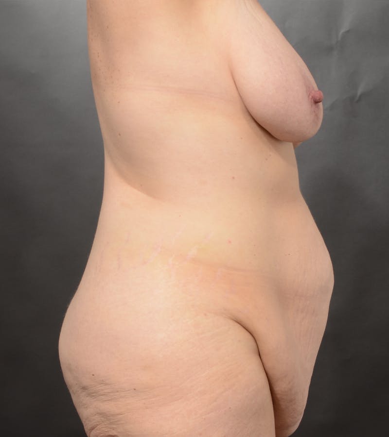 Mommy Makeover Before & After Gallery - Patient 227038 - Image 5