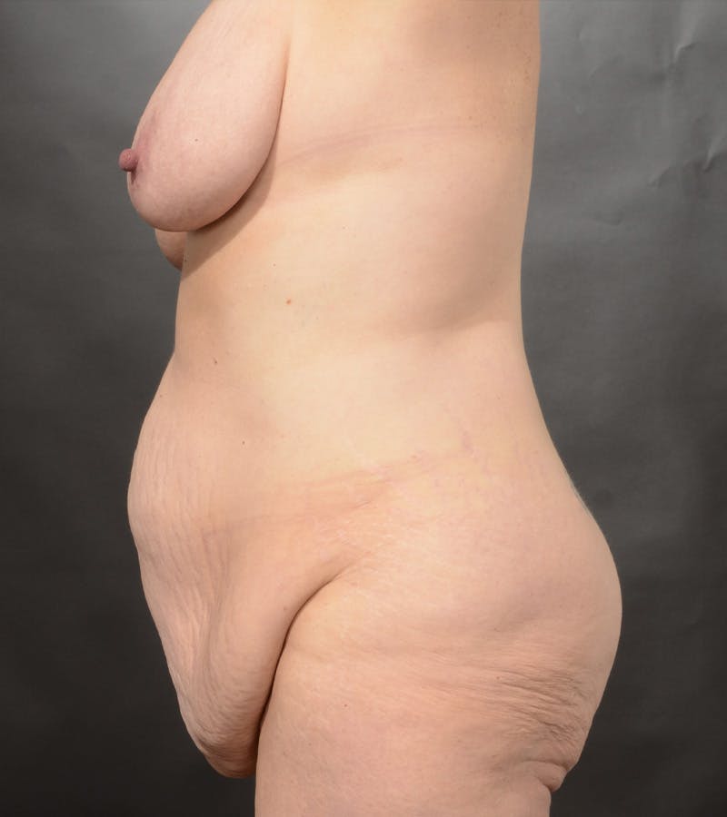 Mommy Makeover Before & After Gallery - Patient 227038 - Image 7