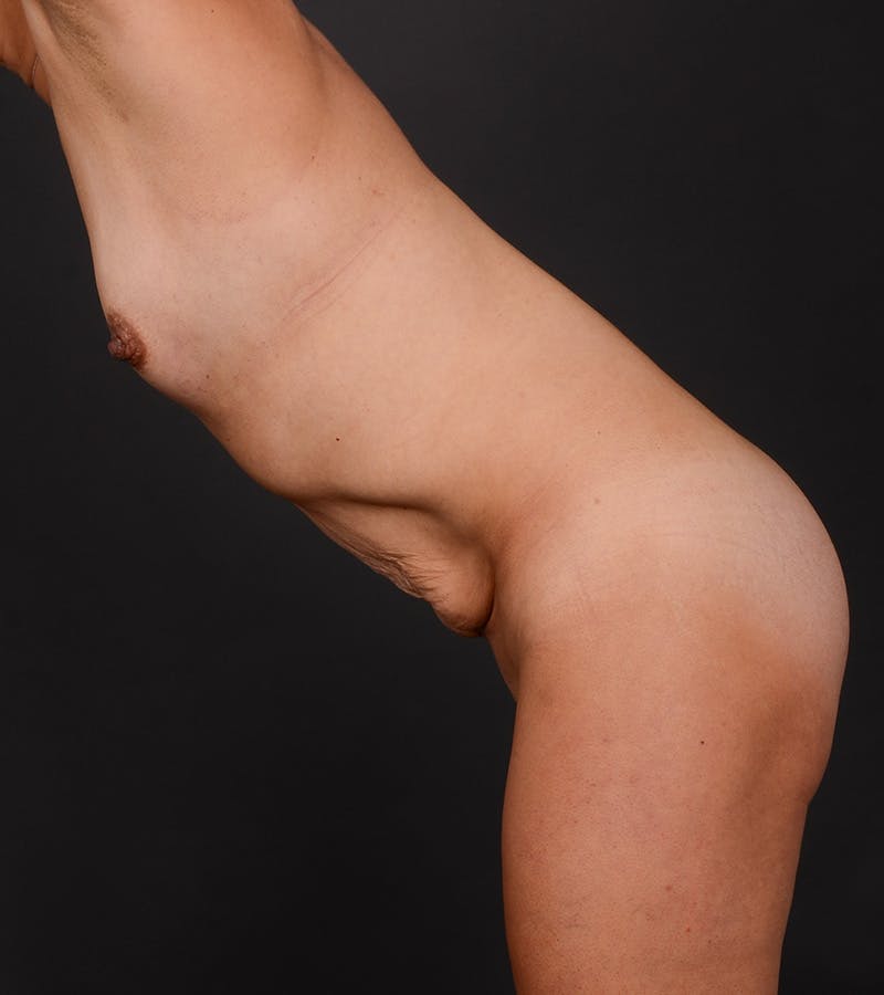 Mommy Makeover Before & After Gallery - Patient 167704 - Image 9