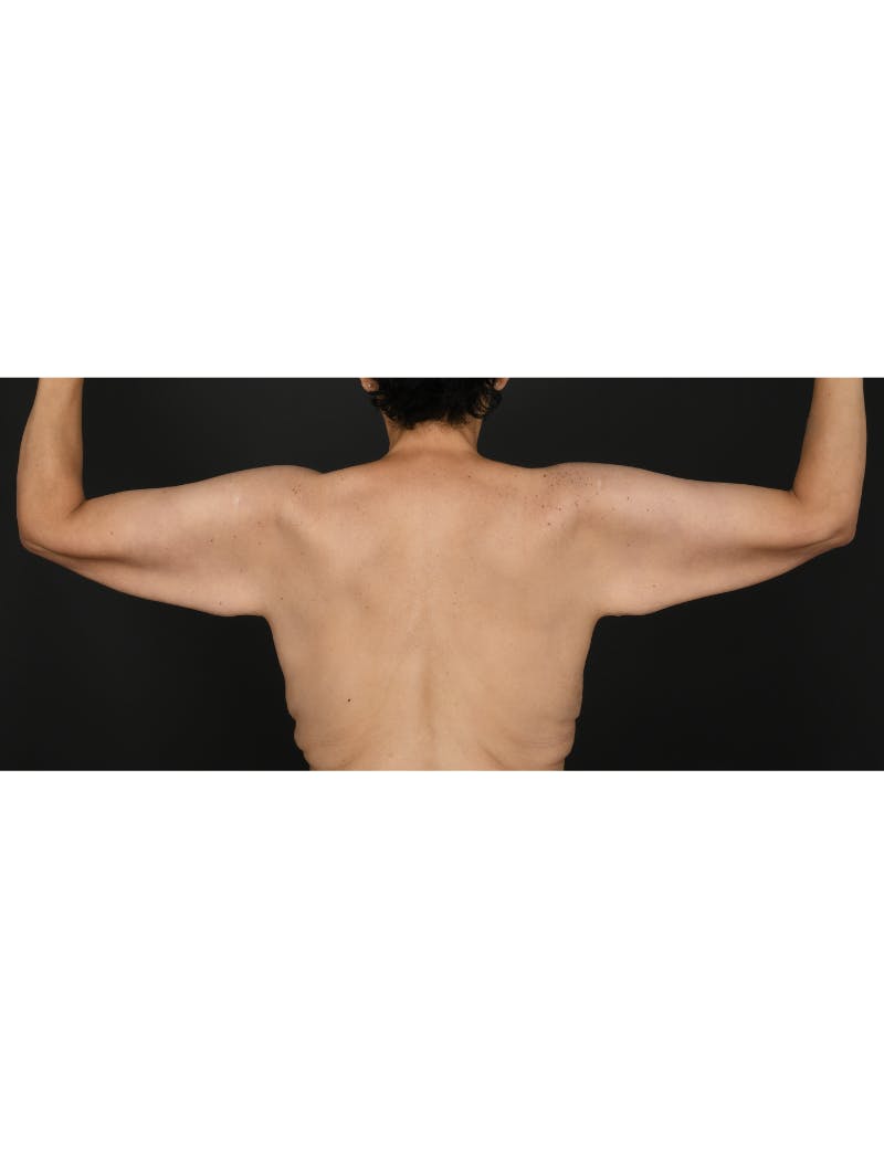 Arm Lift Before & After Gallery - Patient 365201 - Image 5