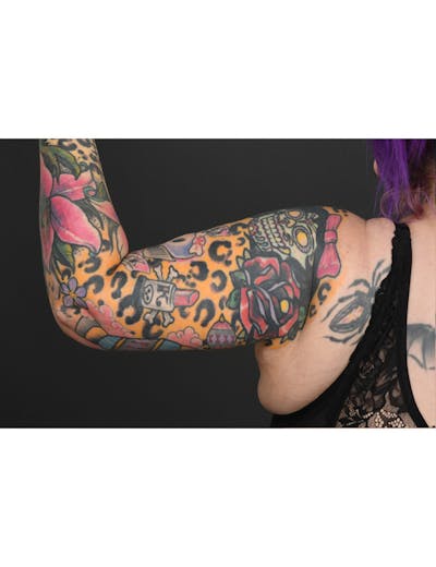 Arm Lift Before & After Gallery - Patient 205421 - Image 2