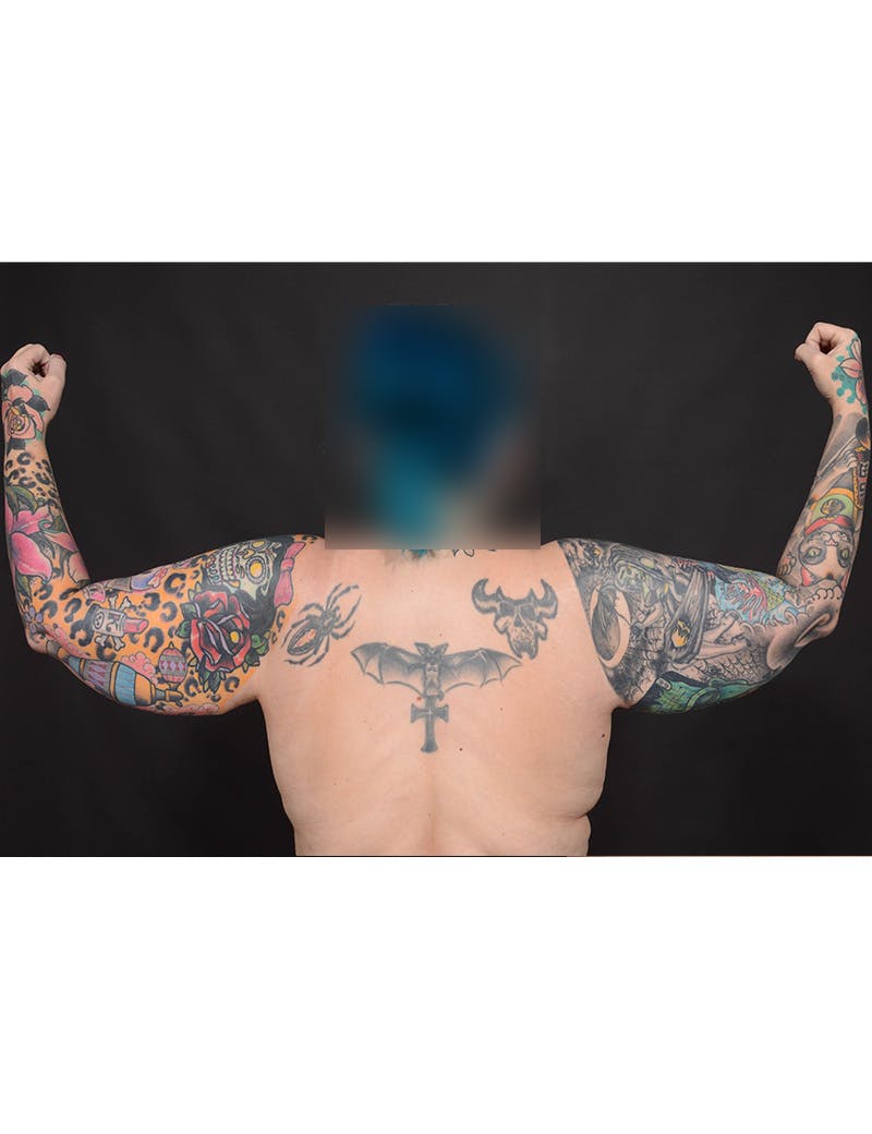 Arm Lift Before & After Gallery - Patient 205421 - Image 3