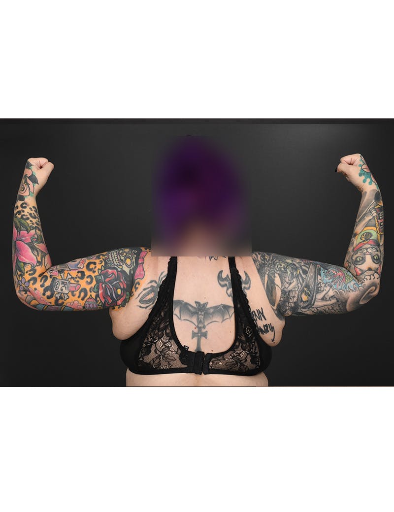 Arm Lift Before & After Gallery - Patient 205421 - Image 4