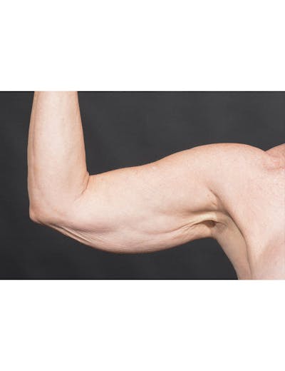 Arm Lift Before & After Gallery - Patient 368505 - Image 1
